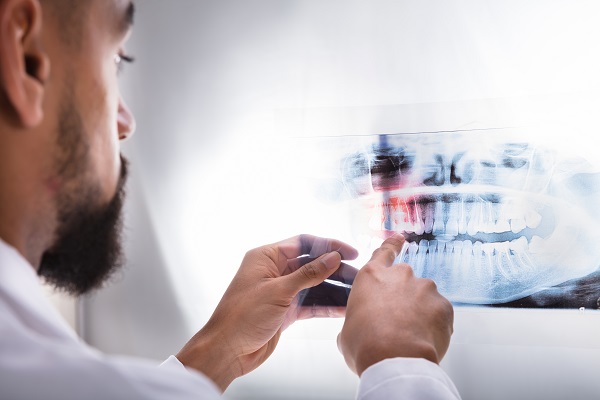 When Is A Root Canal Recommended?