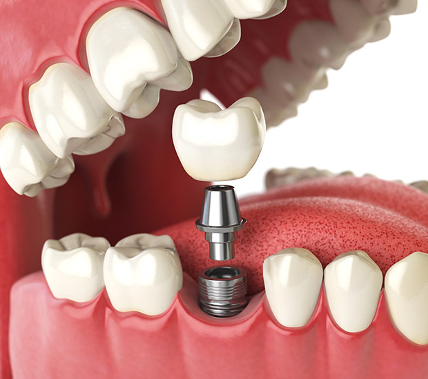 Oro Valley Will I Need a Bone Graft for Dental Implants
