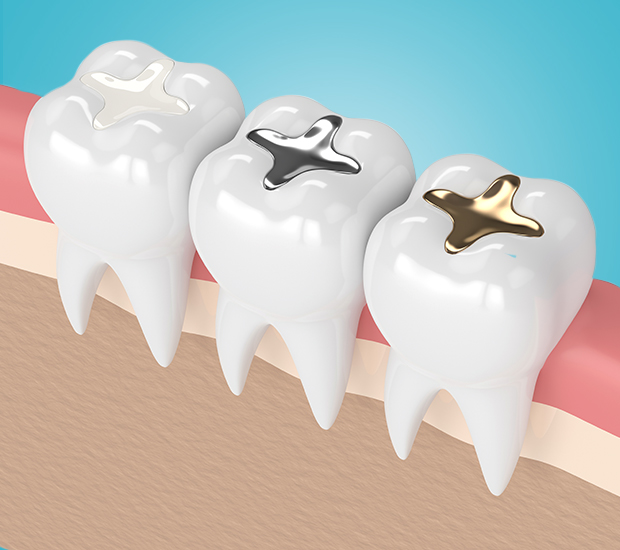 Oro Valley Composite Fillings