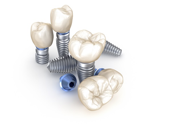 Dental Implant Restoration Oro Valley, AZ