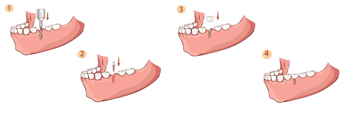 Oro Valley Dental Implant Restoration