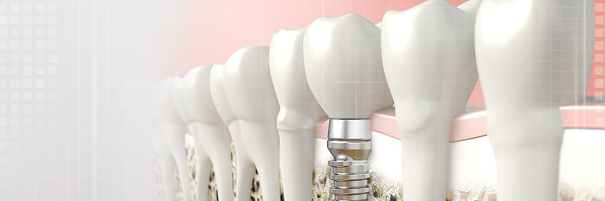 Oro Valley Dental Prosthetics