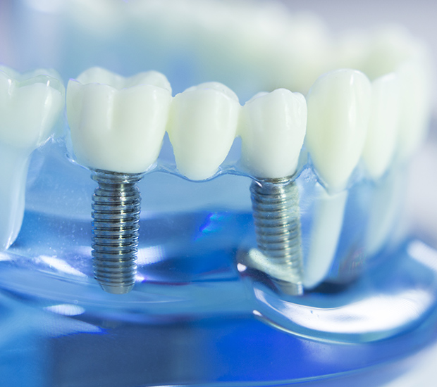 Oro Valley Dental Implants