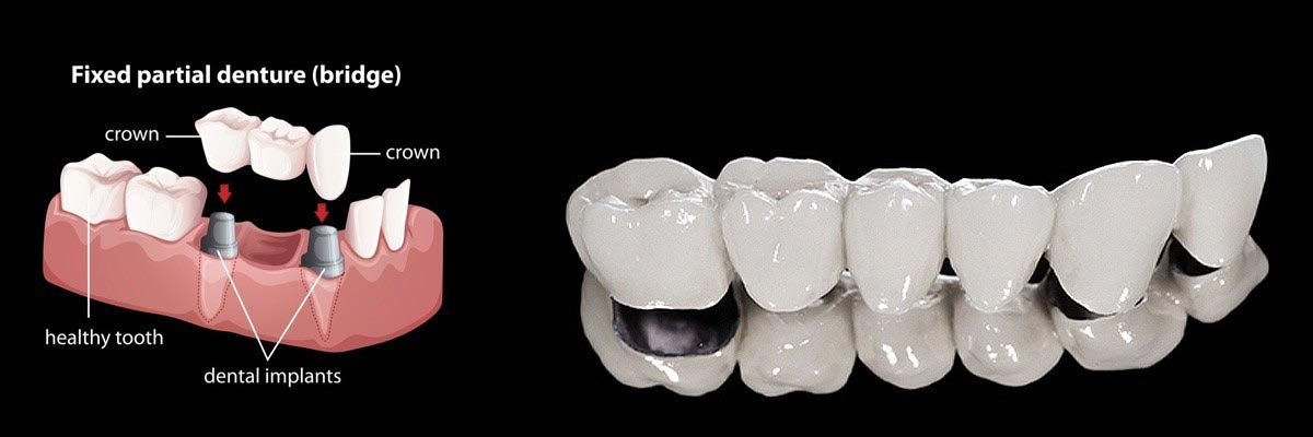 Oro Valley Dentures