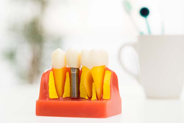 Can I Have Braces If I Have A Dental Implant?