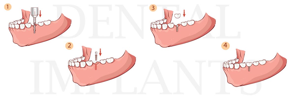 Oro Valley The Difference Between Dental Implants and Mini Dental Implants