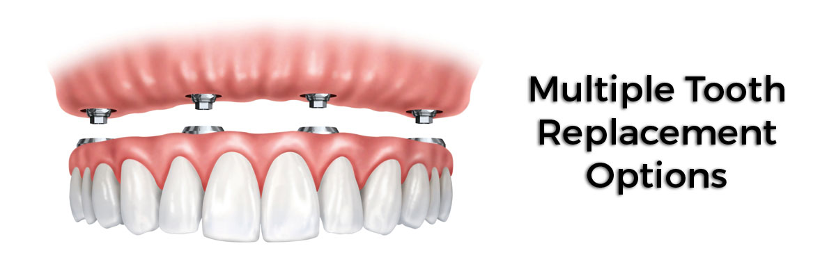 Oro Valley Multiple Teeth Replacement Options