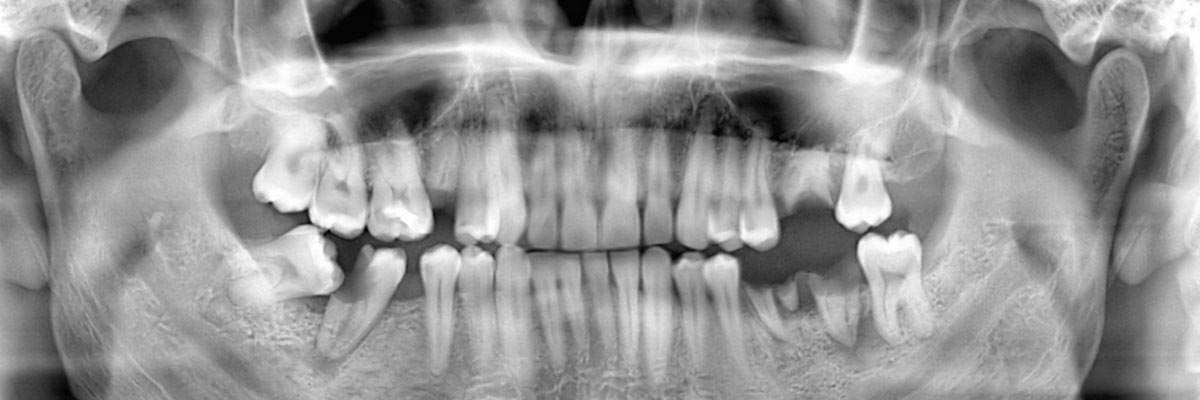 Oro Valley Options for Replacing Missing Teeth